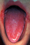 گزارش چهار مورد التهاب گوشه لب (Angula Cheilitis) در بیماران ارتودنسی