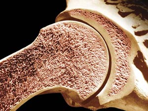 بررسی تراکم معدنی استخوان در بیماران مبتلا به سنگهای ادراری