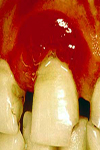 ارزیابی فلور قارچی و فراوانی عفونت های قارچی در دهان بیماران دیابتی