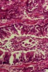 ایوزینوفیلی خون محیطی و سابقه آلرژی در بیماران با بیماری عروق کرونر