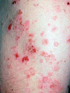 نوکاردیوز جلدی و ریوی در یک بیمار مبتلا به بیماری پمفیگوس