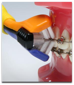 بهداشت دهان و دندان هنگام درمان ارتودنسی