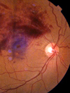 نوروتومی دیسک بینایی از طریق ویترکتومی در نوروپاتی ایسکمیک قدامی غیر آرتریتی