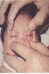 مطالعه میکروبی بیماری افتالمیانیونیتارم در نوزادان متولد شده در بیمارستان شهید بهشتی یاسوج ۱۳۷۹-۱۳۷۸