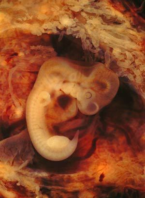 حاملگی نابجا یا اکتوپیک