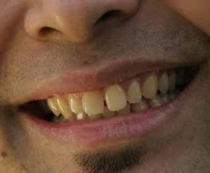مقدار پوسیدگی دندان، به شکل و نوع ماده غذایی بستگی دارد