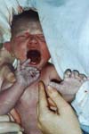 استفراغ خونی حجیم و سوراخ شدگی حاد معدی بعد از تهویه مکانیکی در یک نوزاد