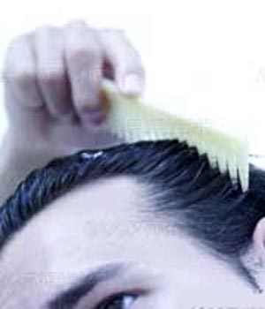 ریزش مو در مردان جوان قبل از سن ۲۱ سالگی