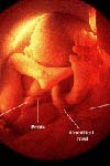 ارتباط بین موفقیت لانه گزینی جنین با خصوصیات گزارش شده در سونوگرافی داپلر آندومتر در برنامه های کمک باروری