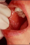 بررسی روش ایمونوفلورسانس مستقیم در تشخیص ضایعات لیکن پلان دهانی