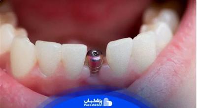 عوارض ایمپلنت فوری دندان چیست؟