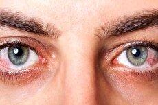 ۶ بیماری مهم که چشم‌ها در مورد آن‌ها هشدار می‌دهند
