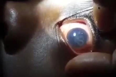 ببینید | بیماری وحشتناک کرم چشم در آفریقا!
