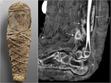 رازهای یک کودک مومیایی‌شده از پزشکی باستانی