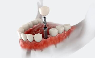 چرا دندانپزشکان ایمپلنت سوئیسی Sic را پیشنهاد می‌دهند؟