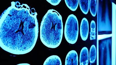 تومور مغزی بیمار 13 ساله برای اولین‌بار در جهان به‌طور کامل درمان شد