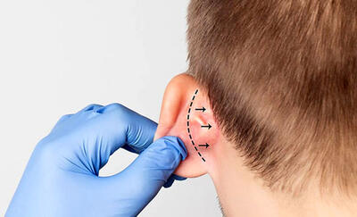 درمان دائمی گوش های برجسته پیدا شد