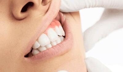 لمینت دندان بدون تراش سرامیکی | مزایا، معایب، ماندگاری و قیمت