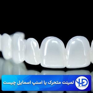 بررسی و انتخاب لمینت متحرک دندان اسنپ آن اسمایل