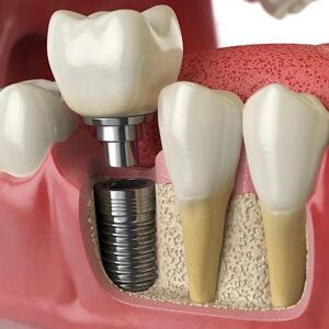 مراحل ایمپلنت دندان چیست؟