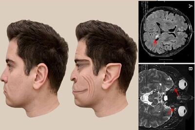 بیماری نادری که چهره افراد را مثل فیلترهای «تیک‌تاک» می کند! + عکس
