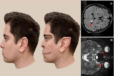 بیماری نادری که باعث می‌شود چهره افراد را شبیه به فیلترهای «تیک‌تاک» ببینید! (+عکس)