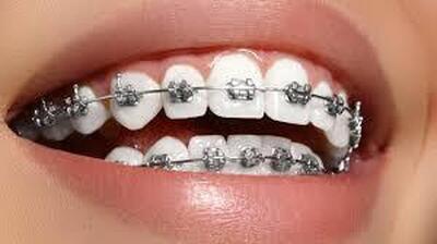 این سن و سال برای ارتودنسی دندان‌ها مناسب است