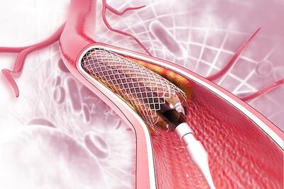 مزایای آنژیوپلاستی در درمان بیماری‌های دریچه‌های قلب
