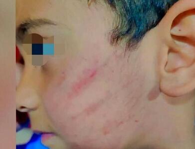 تصویر صورت کتک‌خورده یک دانش آموز کلاس اول خبرساز شد | اقتصاد24