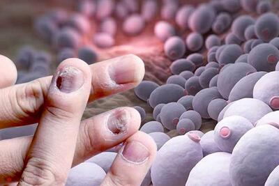 آیا می دانستید عفونت قارچی کشنده‌تر از سرطان و مالاریا است؟ | شبکه اطلاع‌ رسانی طلا و ارز