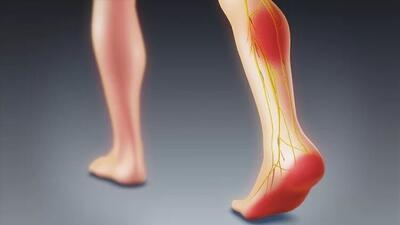 نشانه‌های دردهای سیاتیک  دلیل دردهای لگنی و تیر کشیدن ساق پا را بشناسید