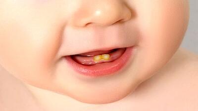 ضرورت مراجعه به واحدهای بهداشتی هنگام رویش اولین دندان کودک