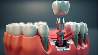 از ایمپلنت دندان چه می‌دانید؟ افرادی که دندان کشیده شده دارند بخوانند!