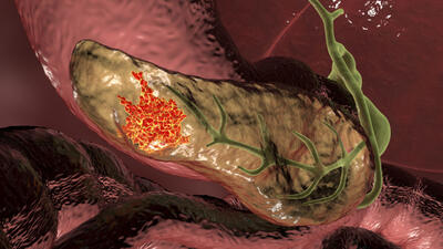 این باکتری، سرطان مرگبار لوزالمعده را درمان میکند؟ - عصر خبر