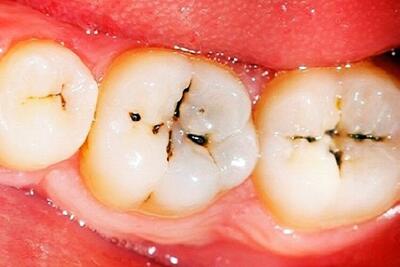 شاخص پوسیدگی دندان در خراسان شمالی نسبت به میانگین کشوری پایین‌تر است
