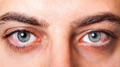 علل شایع خشکی چشم / درمان های خانگی خشکی چشم