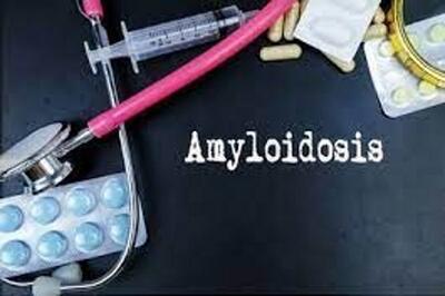  بیماری آمیلوئیدوز و دانستنی های مفید درباره این بیماری