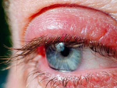 التهاب چشم / علت و راهکارهای درمان آن