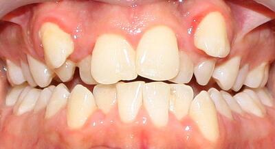 اولین داروی رشد مجدد دندان در جهان مورد آزمایش قرار گرفت