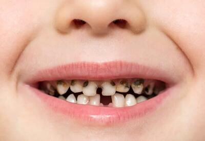 مقام وزارت بهداشت: شایع ترین بیماری بشر پوسیدگی دندان است / ۴۵ درصد از جمعیت جهان از پوسیدگی دندان رنج می برند / به طور متوسط هر کودک ۱۲ ساله ایرانی ۲ دندان پوسیده دارد