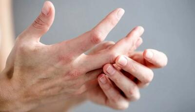 تشخیص یک بیماری از روی انگشتان