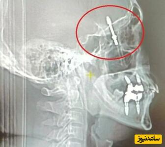 (عکس) اتفاقی عجیب حین انجام ایمپلنت / دندانپزشک پیچ ایمپلنت را در مغز بیمار فرو کرد!
