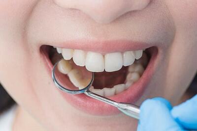 عفونت دندان چه بیماری‌هایی را به دنبال دارد؟