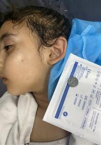 کودک اهل غزه که از سر گرسنگی باتری ساعت بلعیده بود - تسنیم