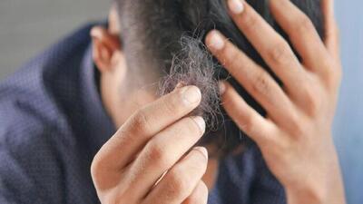 یک درمان جدید برای رویش مجدد موی بیماران خودایمنی
