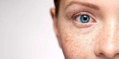 درمان و رفع کک مک پوستی با لیزر اربیوم