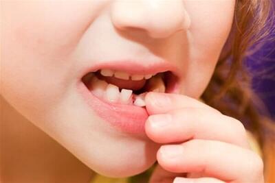دندان شیری کی می‌افتد؟