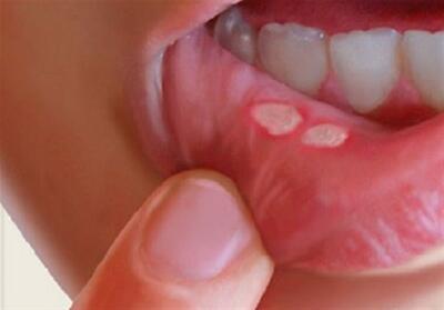 چگونه  آفْت دهان  خود را با چند راهکار طب سنتی درمان کنیم؟ | پایگاه خبری تحلیلی انصاف نیوز