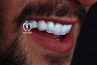 اهمیت انتخاب برند مناسب برای کامپوزیت‌ دندان