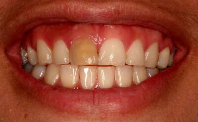 تغییر رنگ دندان عصب کشی شده، علت و راهکار